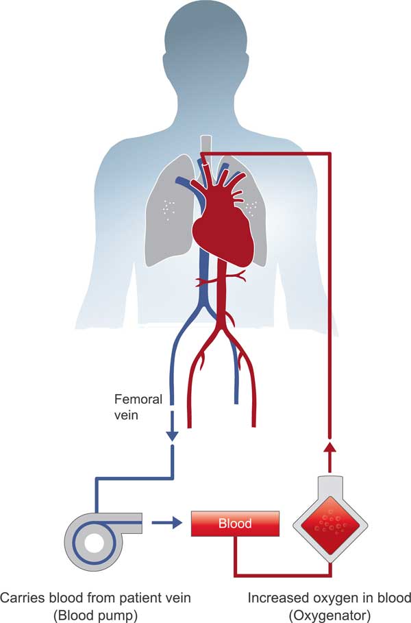 normothermic-nrp-1 Normothermic Regional Perfusion (NRP) Services